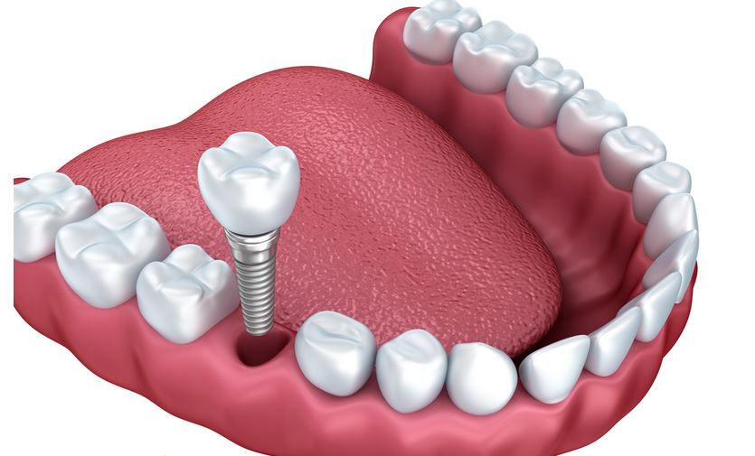 implant-dentist
